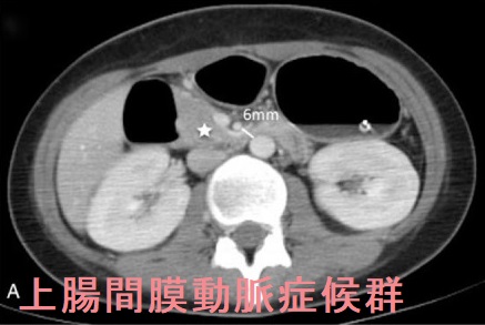 上腸間膜動脈症候群 造影CT