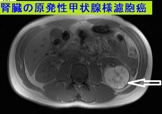 腎臓の原発性甲状腺様濾胞癌 MRI画像