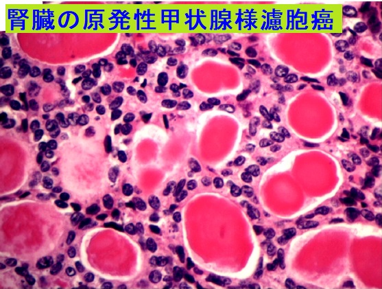 腎臓の原発性甲状腺様濾胞癌 組織像