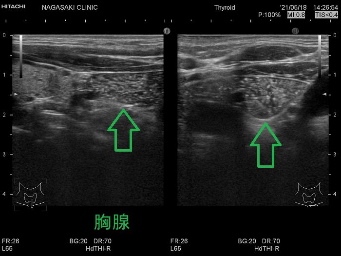 13歳の女児、甲状腺直下の異所性胸腺 超音波(エコー)画像