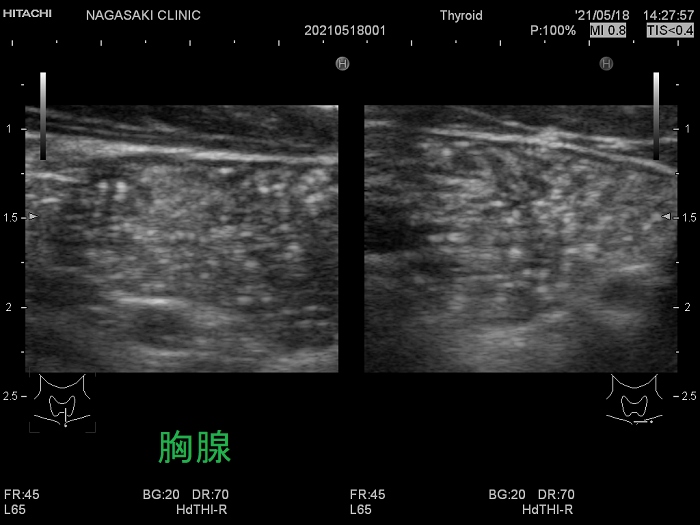 13歳の女児、甲状腺直下の異所性胸腺（拡大）超音波(エコー)画像