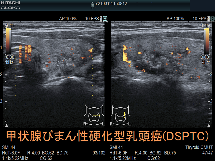 甲状腺びまん性硬化型乳頭癌(DSPTC) 超音波(エコー)画像 ドプラーモード