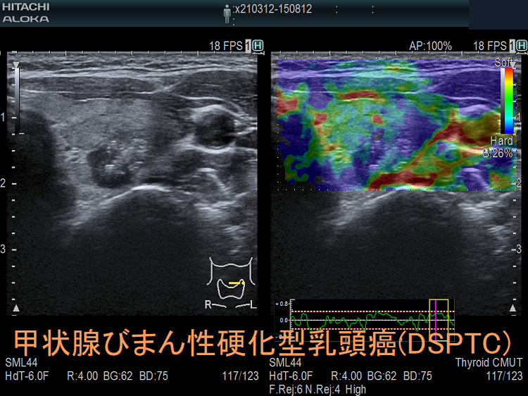 甲状腺びまん性硬化型乳頭癌(DSPTC) 超音波(エコー)画像 エラストグラフィー