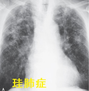 珪肺症
