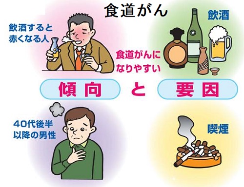 食道がん