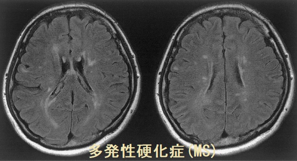 多発性硬化症(MS)　MRI画像
