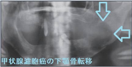 甲状腺濾胞癌の下顎骨転移