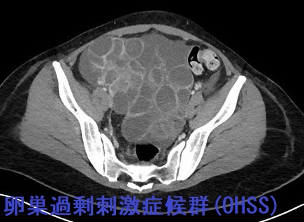 卵巣過剰刺激症候群（OHSS）　CT画像