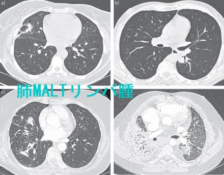 肺MALTリンパ腫 CT画像