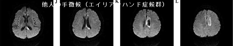 他人の手徴候（エイリアンハンド症候群）MRI拡散強調画像