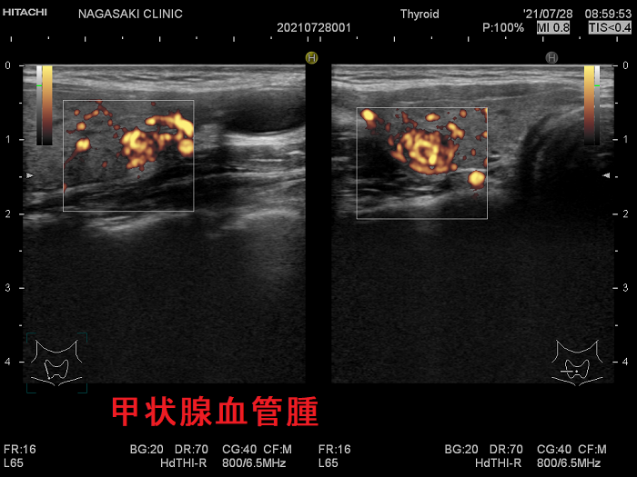 甲状腺血管腫 超音波(エコー)画像 ドプラー