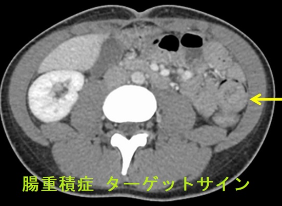 腸重積症 造影CT検査 ターゲットサイン