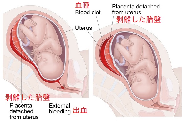 胎盤早期剥離