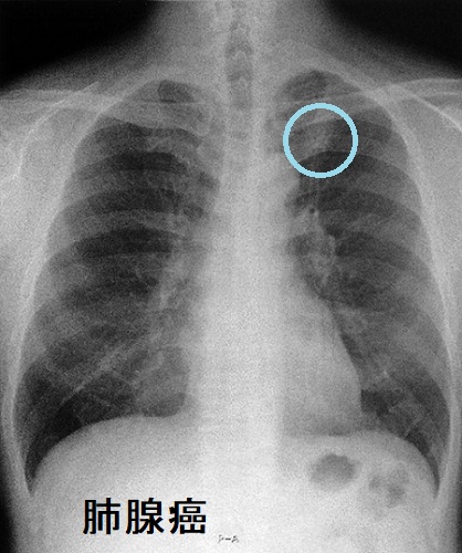 肺腺癌 胸部X-p写真