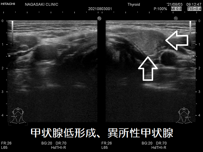 上頚部の異所性甲状腺（甲状腺低形成）　超音波(エコー)画像