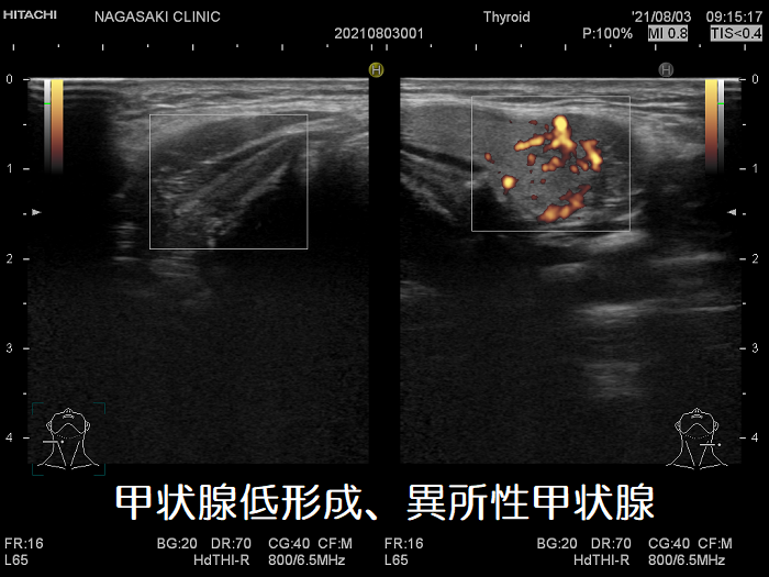 上頚部の異所性甲状腺（甲状腺低形成） 超音波(エコー)画像 ドプラーモード