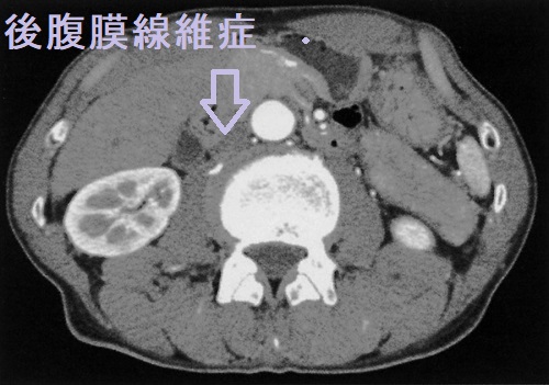 後腹膜線維症 造影CT所見