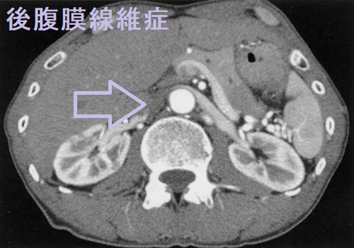 後腹膜線維症 造影CT所見