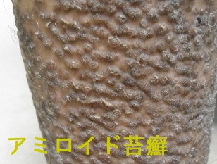 アミロイド苔癬