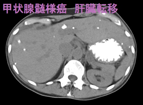 甲状腺髄様癌 肝臓転移 単純CT