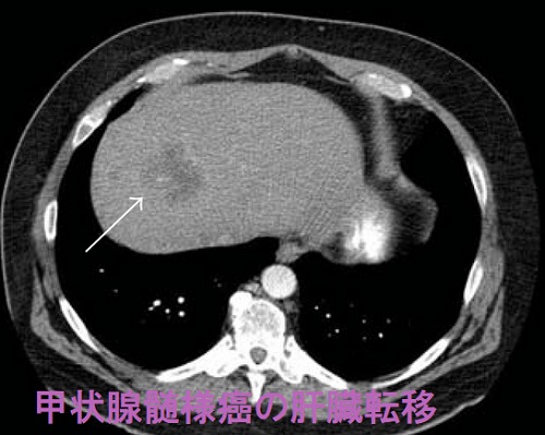 甲状腺髄様癌 肝臓転移 造影CT