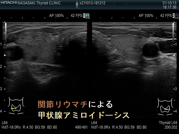 関節リウマチによる甲状腺アミロイドーシス 超音波(エコー)画像