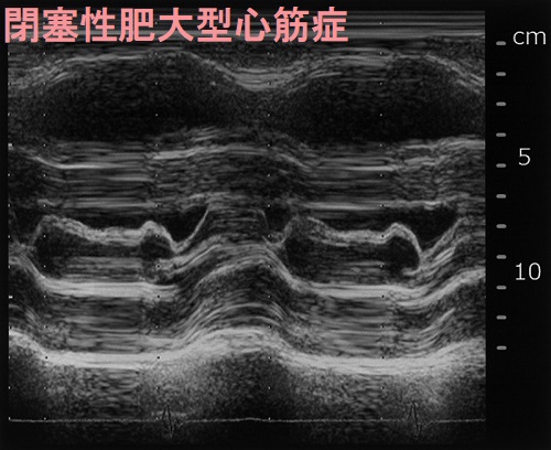 閉塞性肥大型心筋症　超音波(エコー)画像