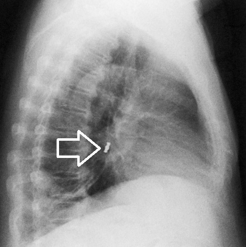 金属製異物（歯冠）による右気管支異物 胸部X線