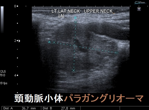 頸動脈小体パラガングリオーマ 超音波（エコー）画像