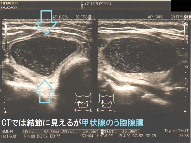 CTでは結節に見えるが甲状腺のう胞腺腫 超音波(エコー)画像