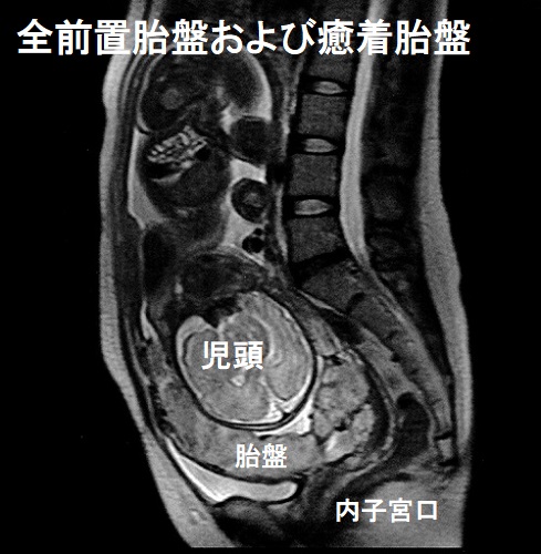 全前置胎盤および癒着胎盤 MRI画像