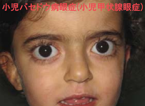 小児バセドウ病眼症（小児甲状腺眼症）1