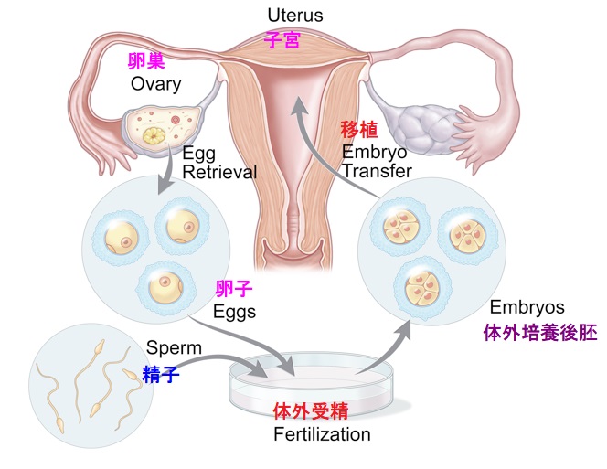 体外受精[IVF]