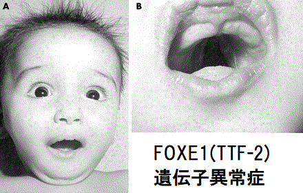 FOXE1(TTF-2)遺伝子異常症