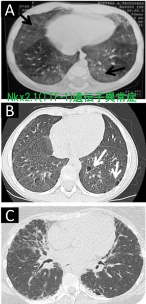 Nkx2.1(TTF-1)遺伝子異常症(Brain-Lung-Thyroid syndrome)