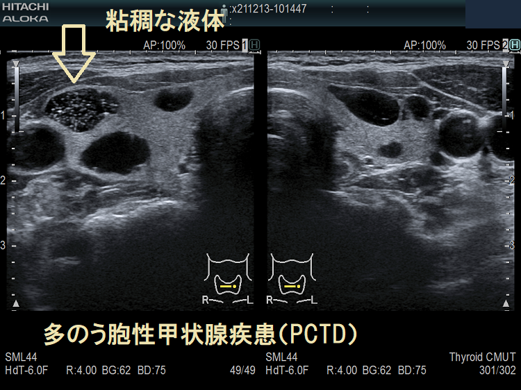 多のう胞性甲状腺疾患（PCTD）粘稠な液体　超音波(エコー)画像