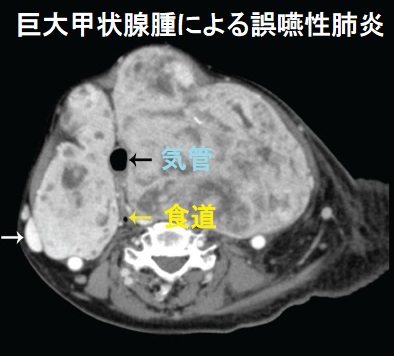 巨大甲状腺腫による誤嚥性肺炎　CT画像