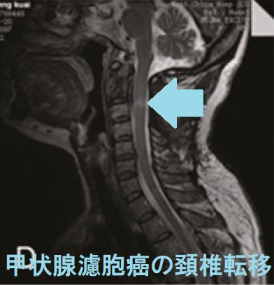 脊椎(頚椎)転移症状は、頸椎浸潤と頚髄圧迫による  頸部痛、上下肢痛 上下肢麻痺 をおこします。（Medicine (Baltimore). 2017 Oct;96(41):e8215.）