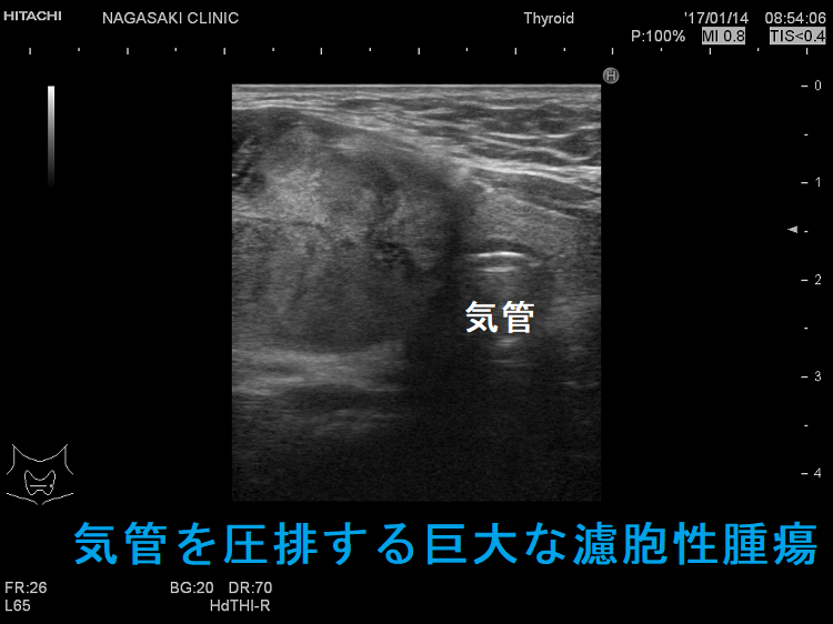甲状腺濾胞癌（気管圧排）超音波（エコー）画像