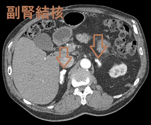 副腎結核 後期　CT画像