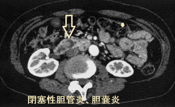 総胆管結石あるいは胆管腫瘍性胆管炎 閉塞性黄疸 CT画像