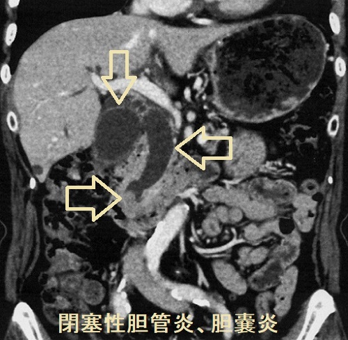 総胆管結石あるいは胆管腫瘍性胆管炎・胆嚢炎 閉塞性黄疸 CT画像