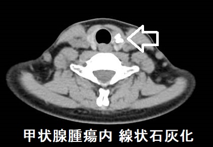 甲状腺腫瘍内 線状石灰化 CT画像