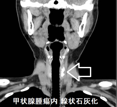 甲状腺腫瘍内 線状石灰化 CT画像