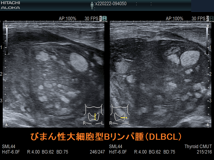 びまん性大細胞型Bリンパ腫（DLBCL） 超音波(エコー)画像