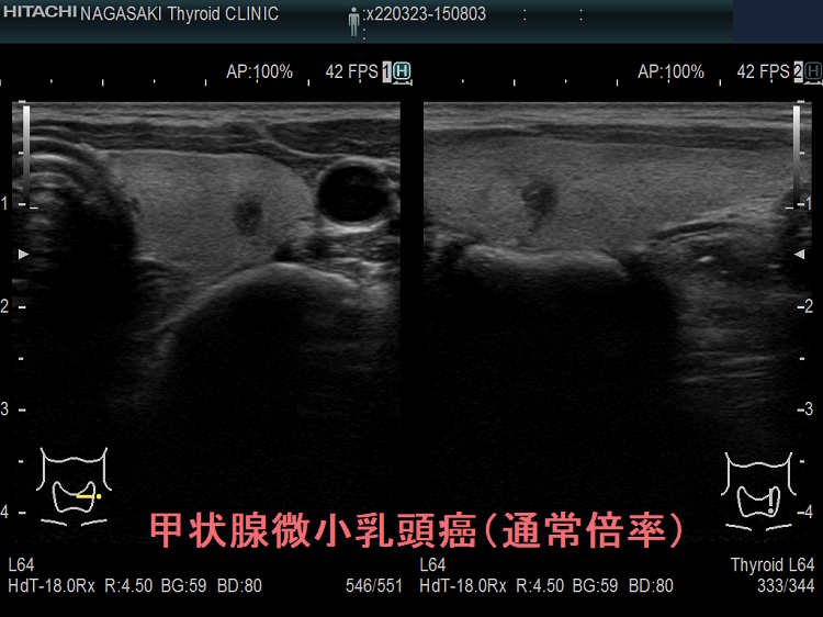 典型的な甲状腺微小乳頭癌 超音波(エコー)画像 通常倍率