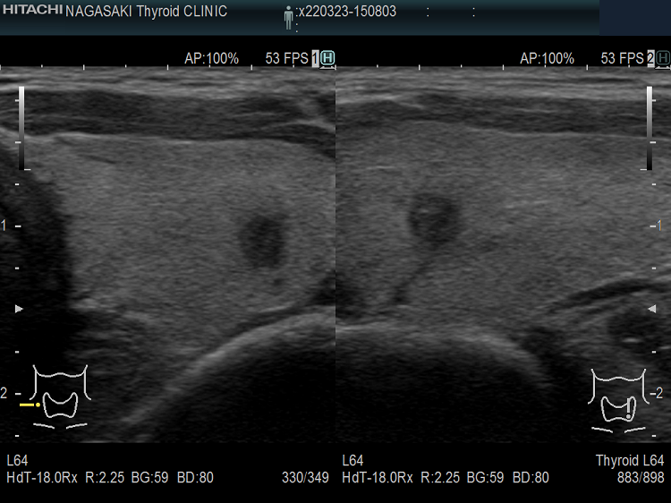 典型的な甲状腺微小乳頭癌 超音波(エコー)画像 （拡大）