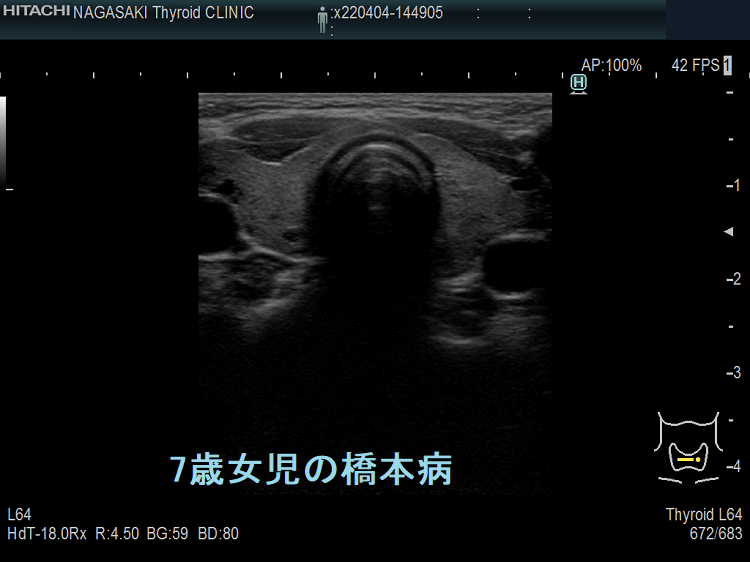 7歳女児の橋本病 超音波（エコー）画像