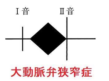 大動脈弁狭窄症の心音 大動脈弁狭窄症の心音