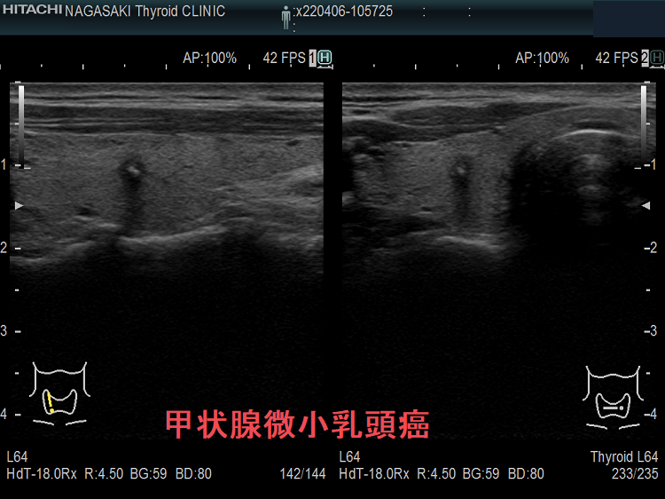 典型的な甲状腺微小乳頭癌 超音波(エコー)画像